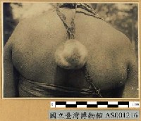 藏品(新幾內亞風土病寫真-疊瓦癬 (渦紋癬))的圖片